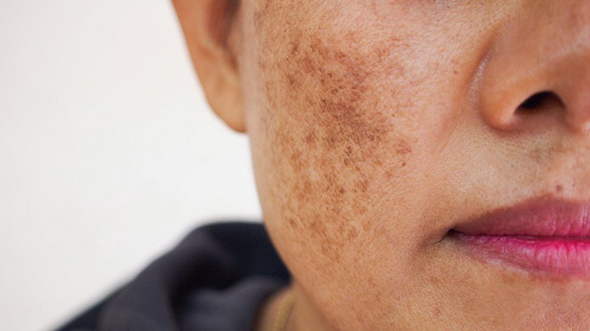 Пигментация иконка