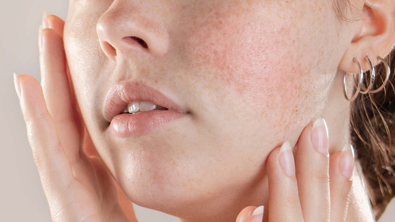 Розацеа и купероз: как ухаживать за кожей