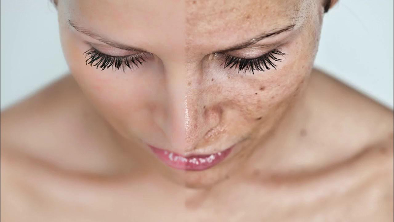 Пигментация кожи: почему возникает и как с ней бороться